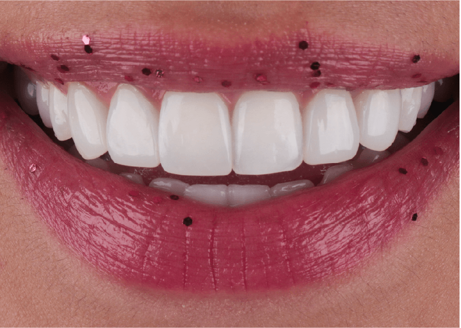 Procedimiento estético en sonrisa